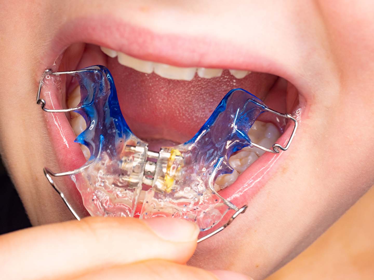 paladar estrecho expansor dientes