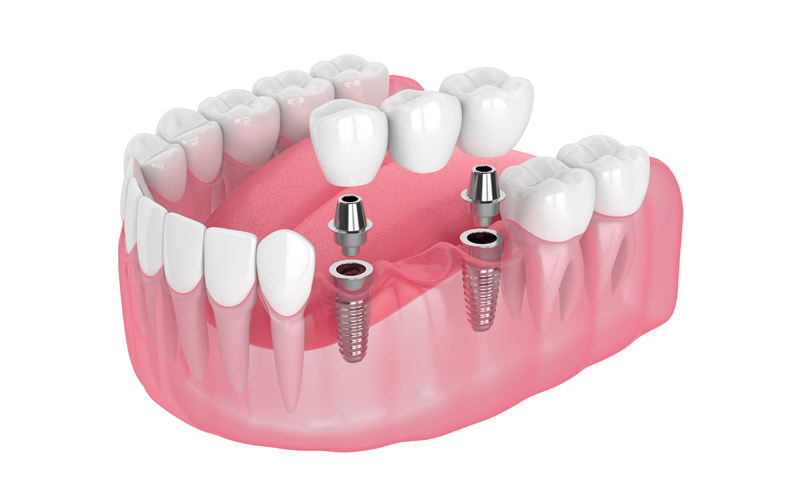 Puente implantes dentales
