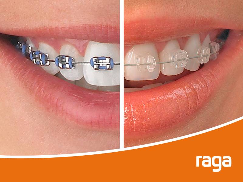 Brackets Met licos Tradicionales