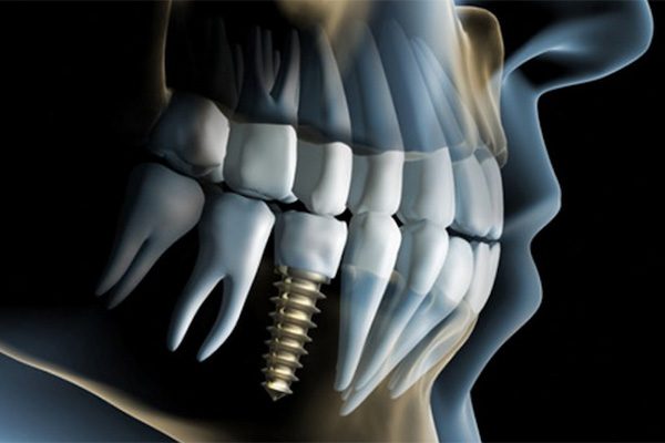 implantes-dentales-raga