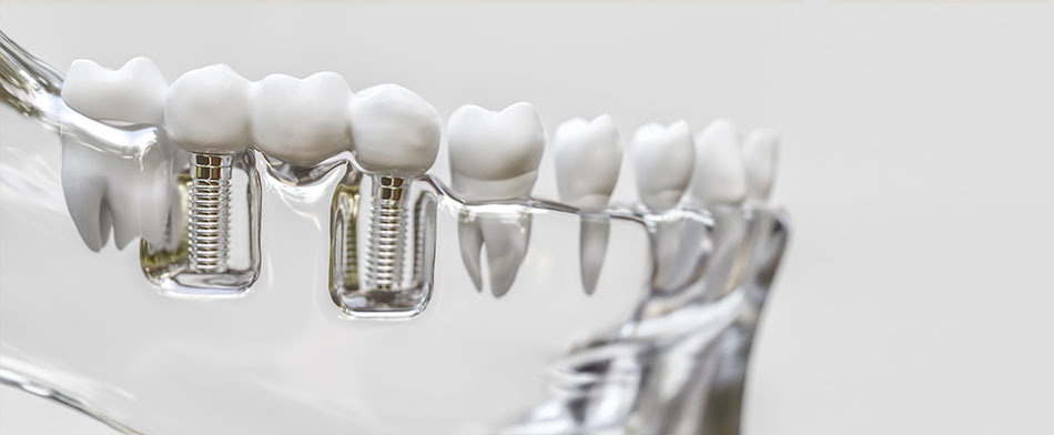 Implantes dentales