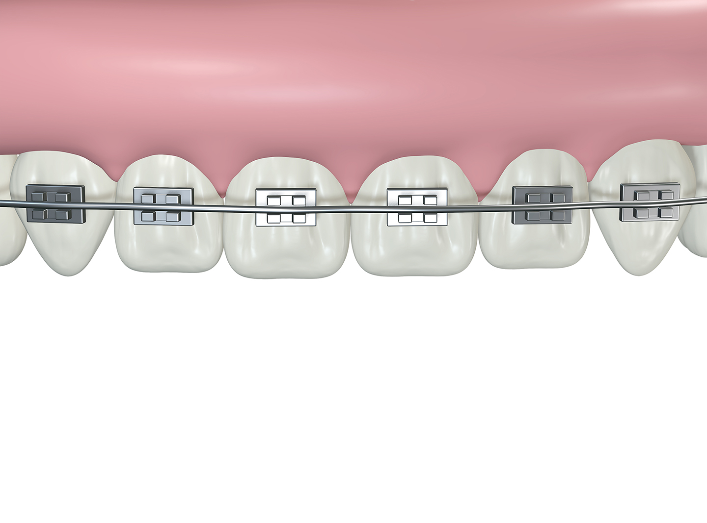 ortodoncia-con-carillas