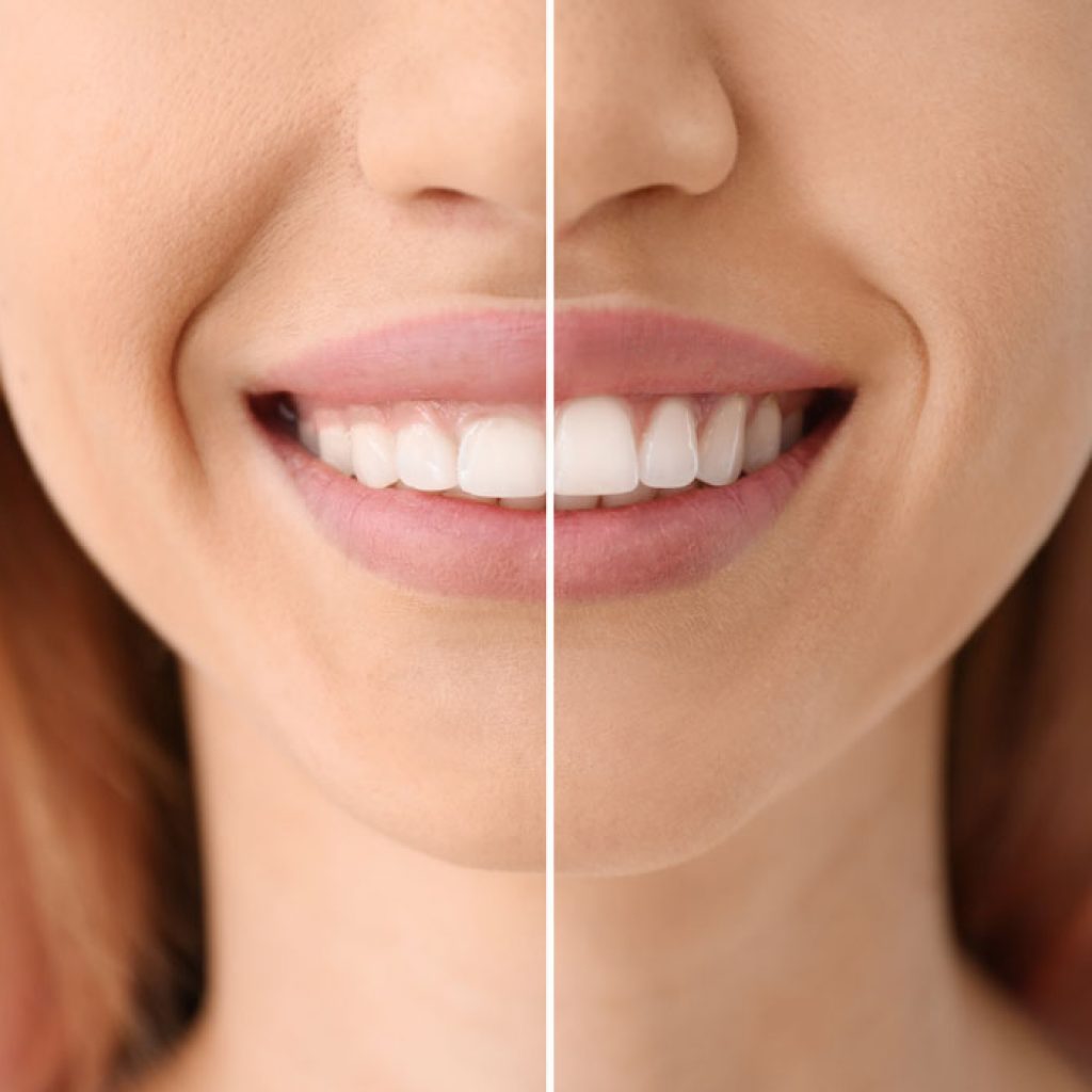 Antes y después tratamientos dentales en Manresa