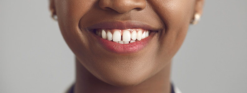 Qué alternativas hay a la ortodoncia para corregir un solo diente