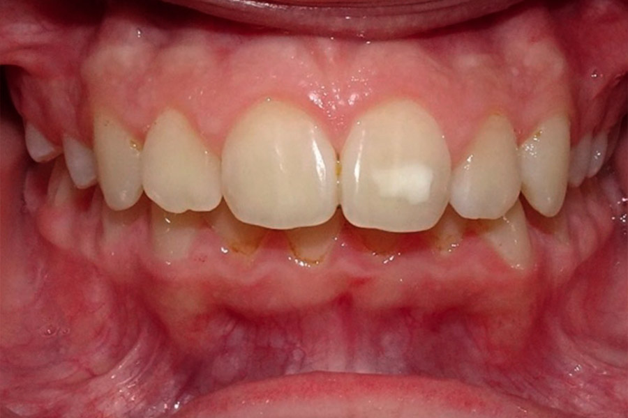 Antes Claudia. Frontal