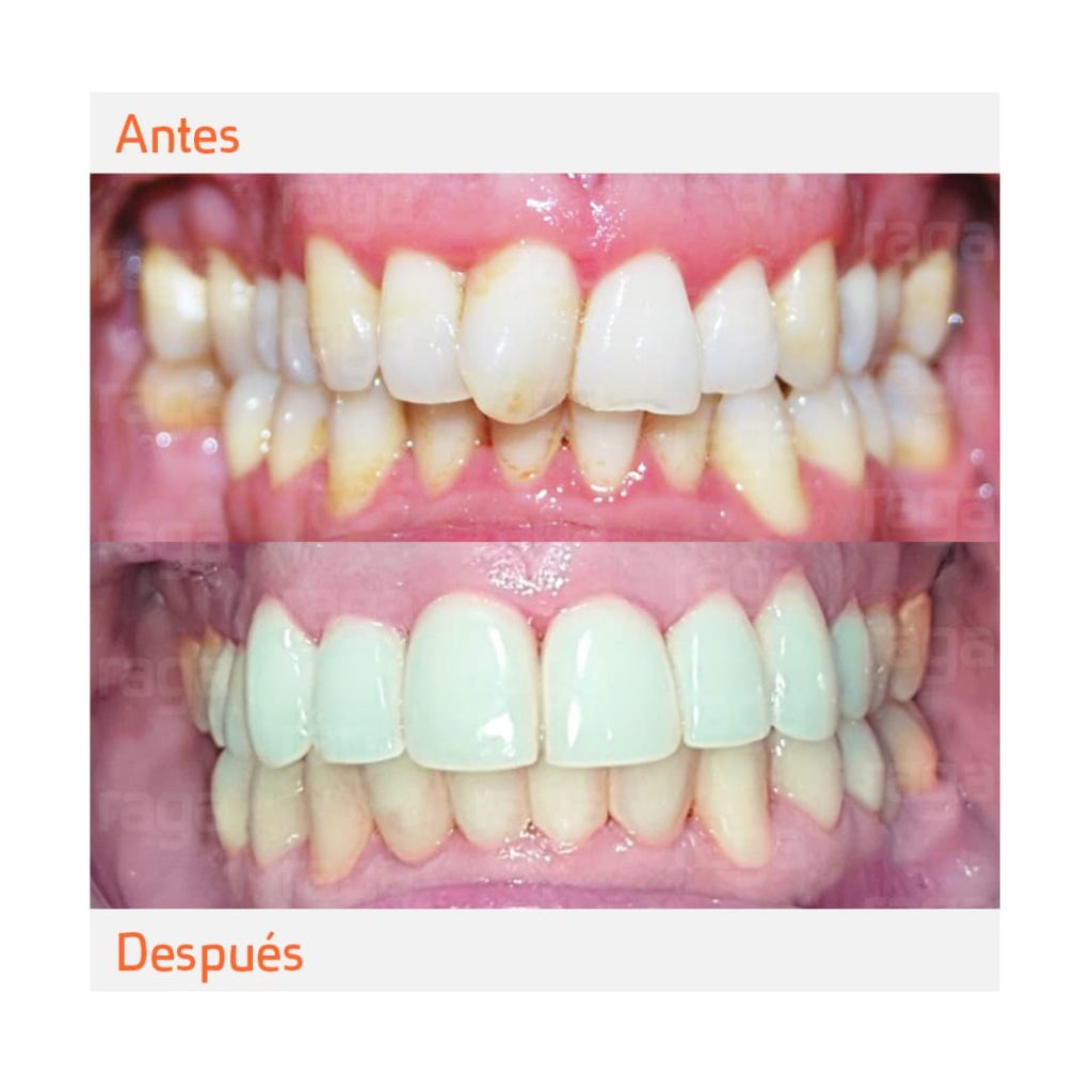 caso clinico carillas dentales antes y despues