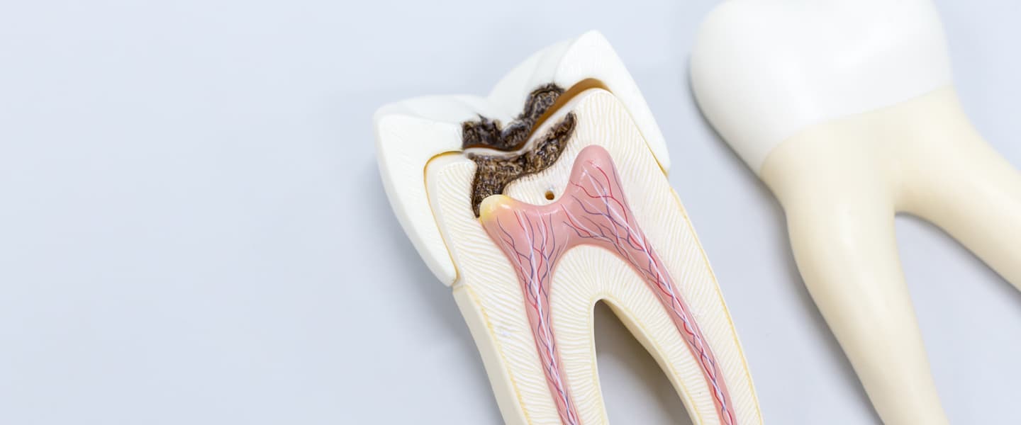 cuanto-dura-una-endodoncia-y-cuando-la-necesitamos