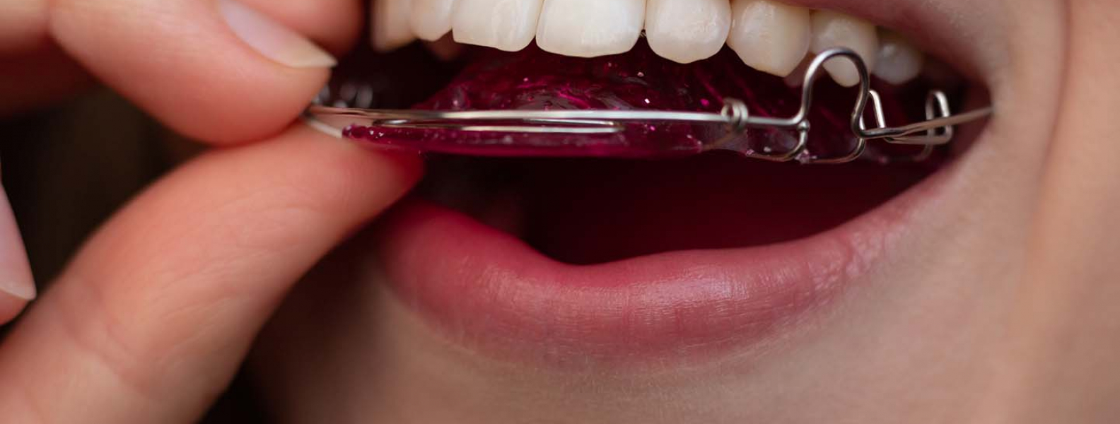 ¿Cómo limpiar los retenedores dentales removibles? | Consejos